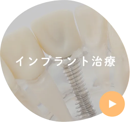 インプラント治療
